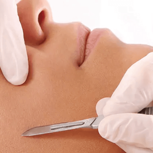Dermaplaning